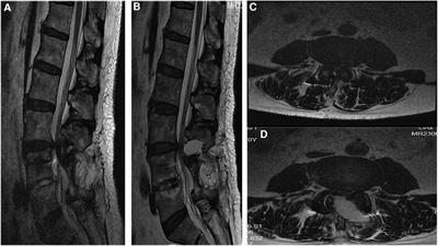 Percutaneous microchannel unilateral approach bilateral micro decompression for adjacent segmental degeneration after lumbar fusion at 10 years: a case report and review of literature